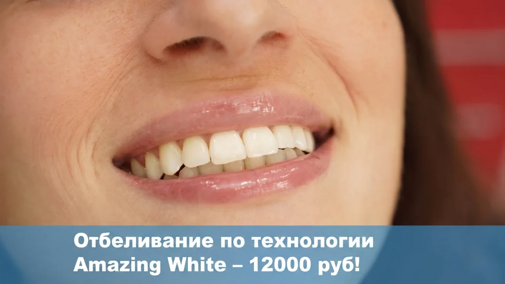 Отбеливание Amazing White — 12 000 руб!